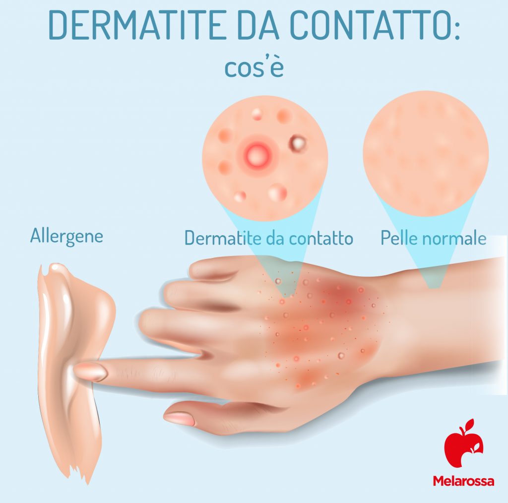 Dermatite Atopica Cause Sintomi Cure E Rimedi Naturali Hot Sex Picture