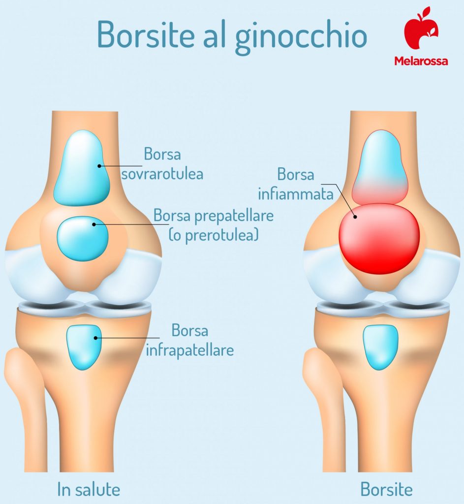 Borsite Che Cos Tipi Cause E Fattori Di Rischio Sintomi Diagnosi