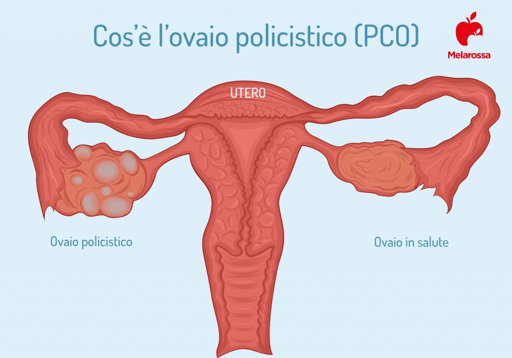 Ovaio Policistico E Sindrome Differenze Sintomi Cause E Cure