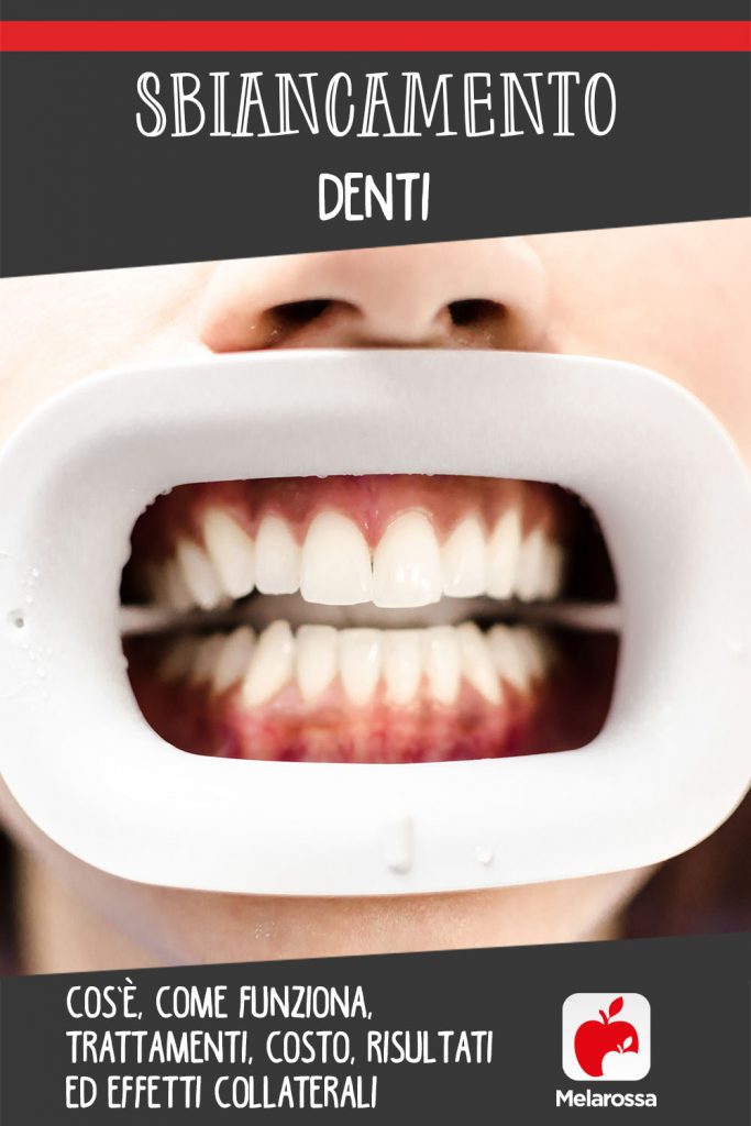 Sbiancamento Denti Cos Come Funziona Costo Risultati