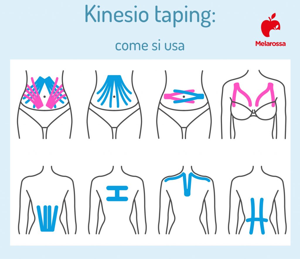 Kinesio taping che cos è a cosa serve come si usa benefici