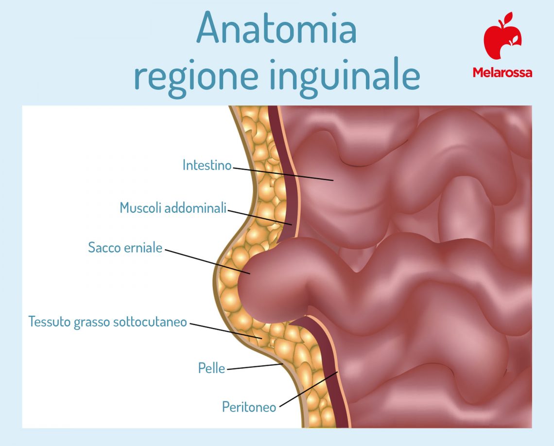 Ernia Inguinale Che Cos Sintomi E Cause Diagnosi Cure