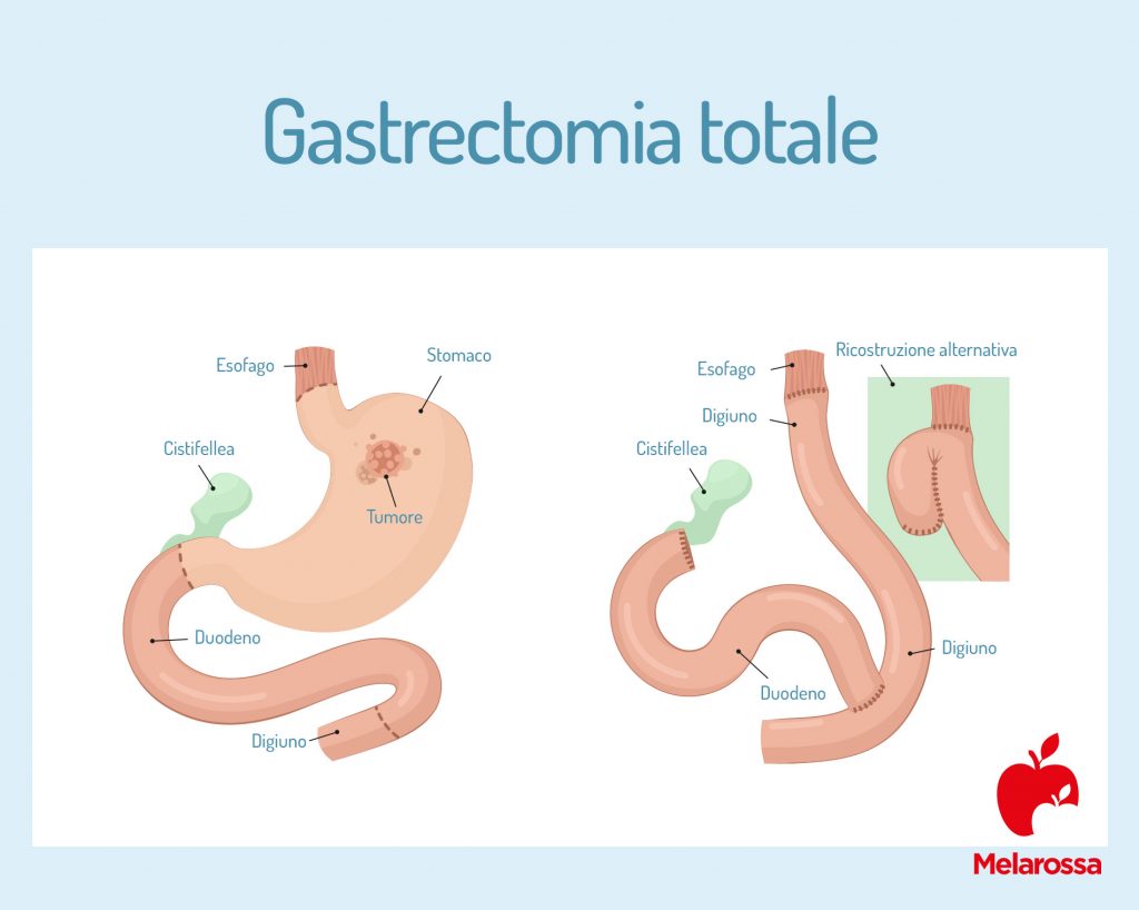 Tumore allo stomaco che cos è cause sintomi diagnosi cure