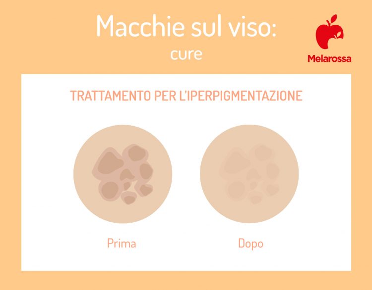 Macchie Sul Viso Come Eliminarle Una Volta Per Tutte