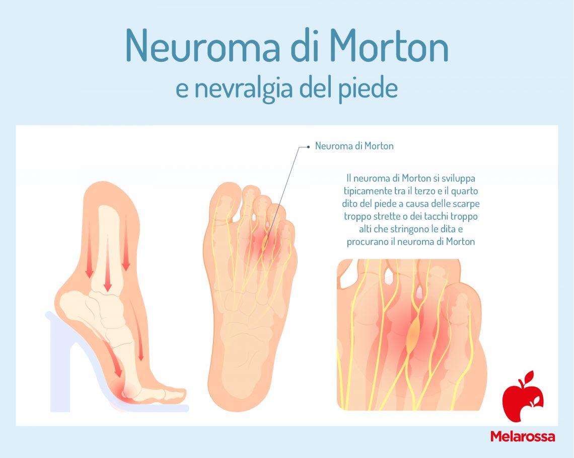 Neuroma Di Morton Che Cos Sintomi E Cause Come Si Cura