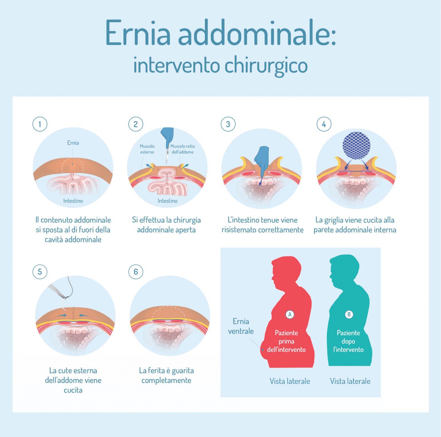 Ernia addominale che cos è sintomi e cause rimedi