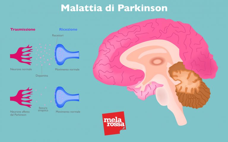 Parkinson: Cos'è, Cause, Tipi, Sintomi, Cura E Prevenzione