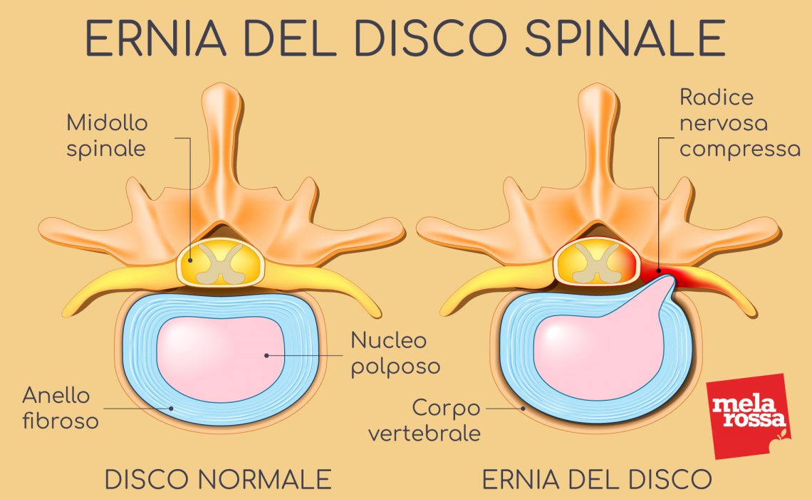 Ernia Del Disco Cervicale I Sintomi E La Diagnosi My Xxx Hot Girl