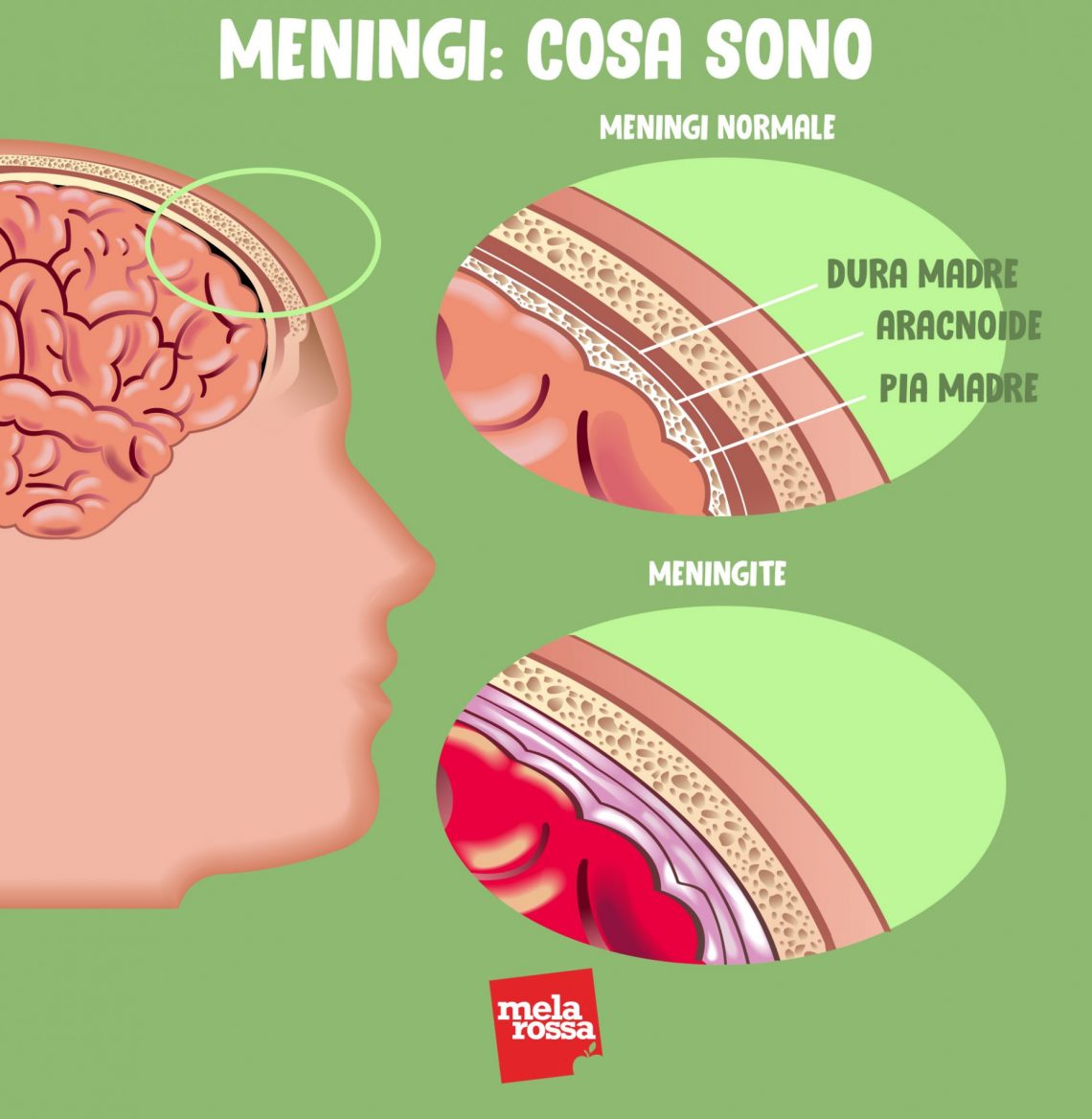 Meningite Cosè Cause Sintomi E Trattamenti Melarossa 7230