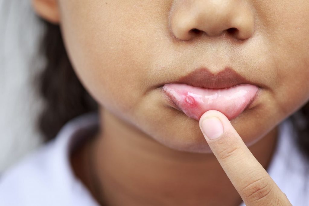 Una bambina che mostra le afte in bocca