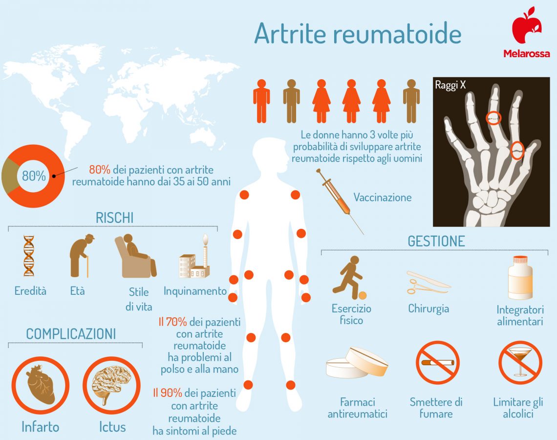 Artrite Reumatoide Che Cosè Cause E Fattori Di Rischio Sintomi Cure