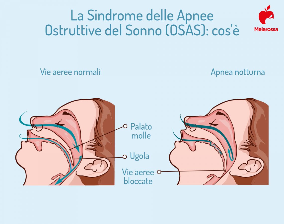 Apnea Notturna Cos Cause Sintomi Conseguenze Cure E Trattamenti