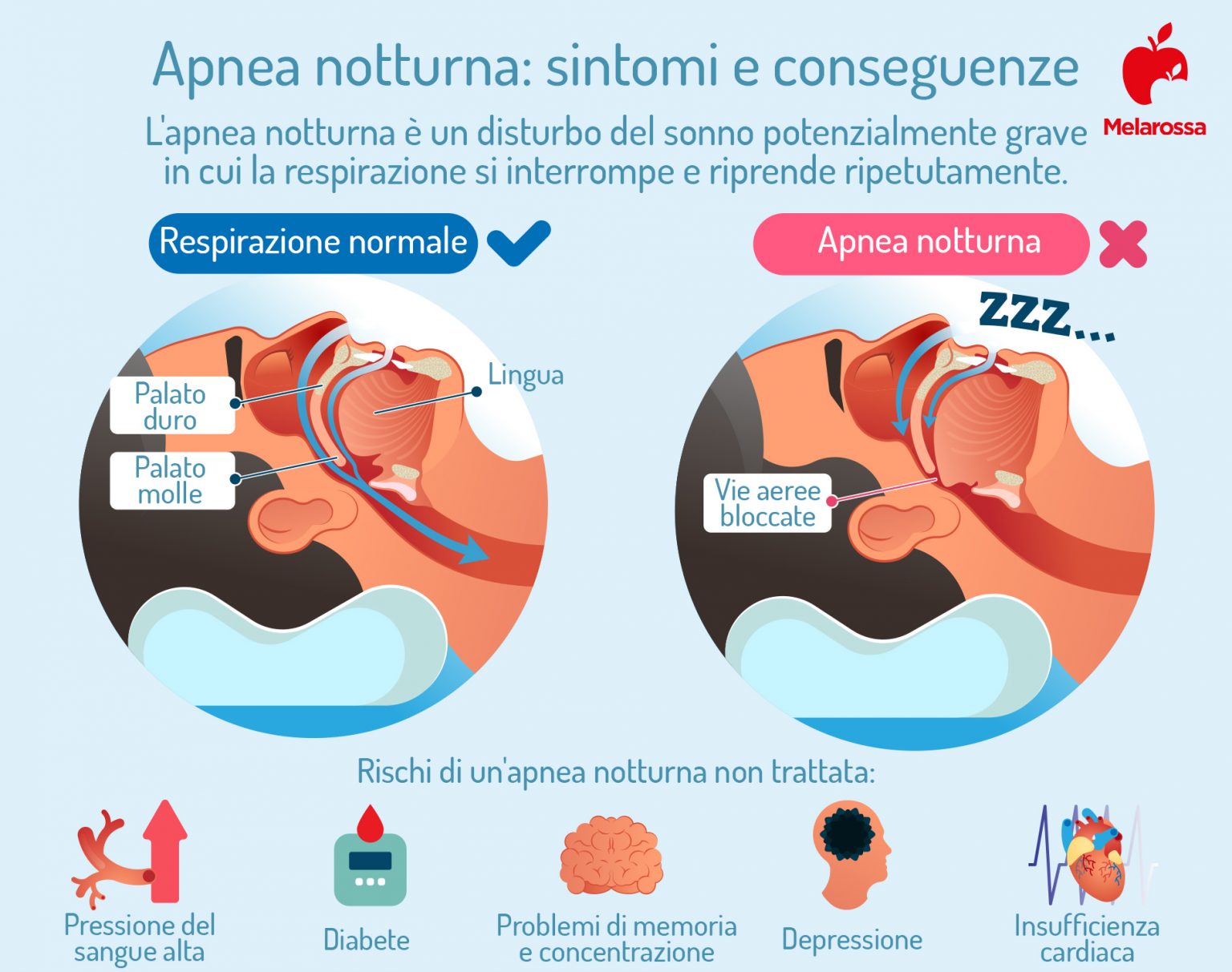 Apnea Notturna Cos Cause Sintomi Conseguenze Cure E Trattamenti