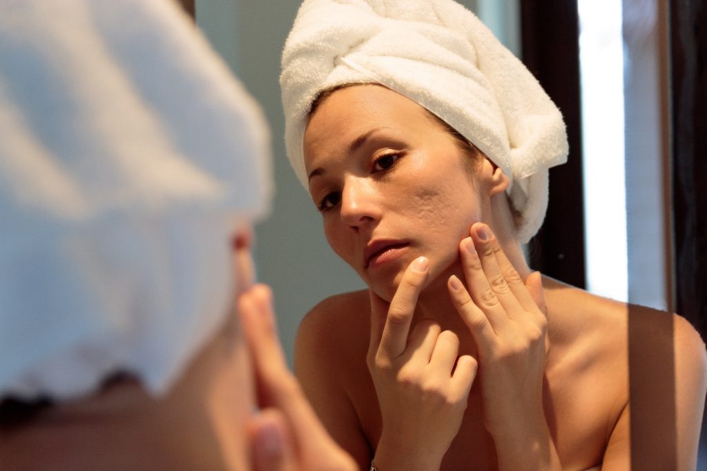 acne: cos'è, tipi, cause, sintomi, cure e trattamenti