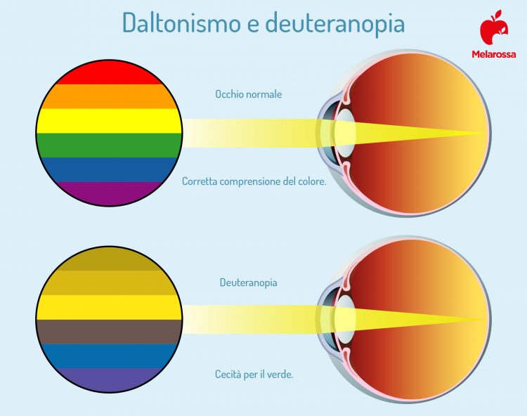 Daltonismo: Cos’è, Le Diverse Forme, Cause, Diagnosi E Trattamento