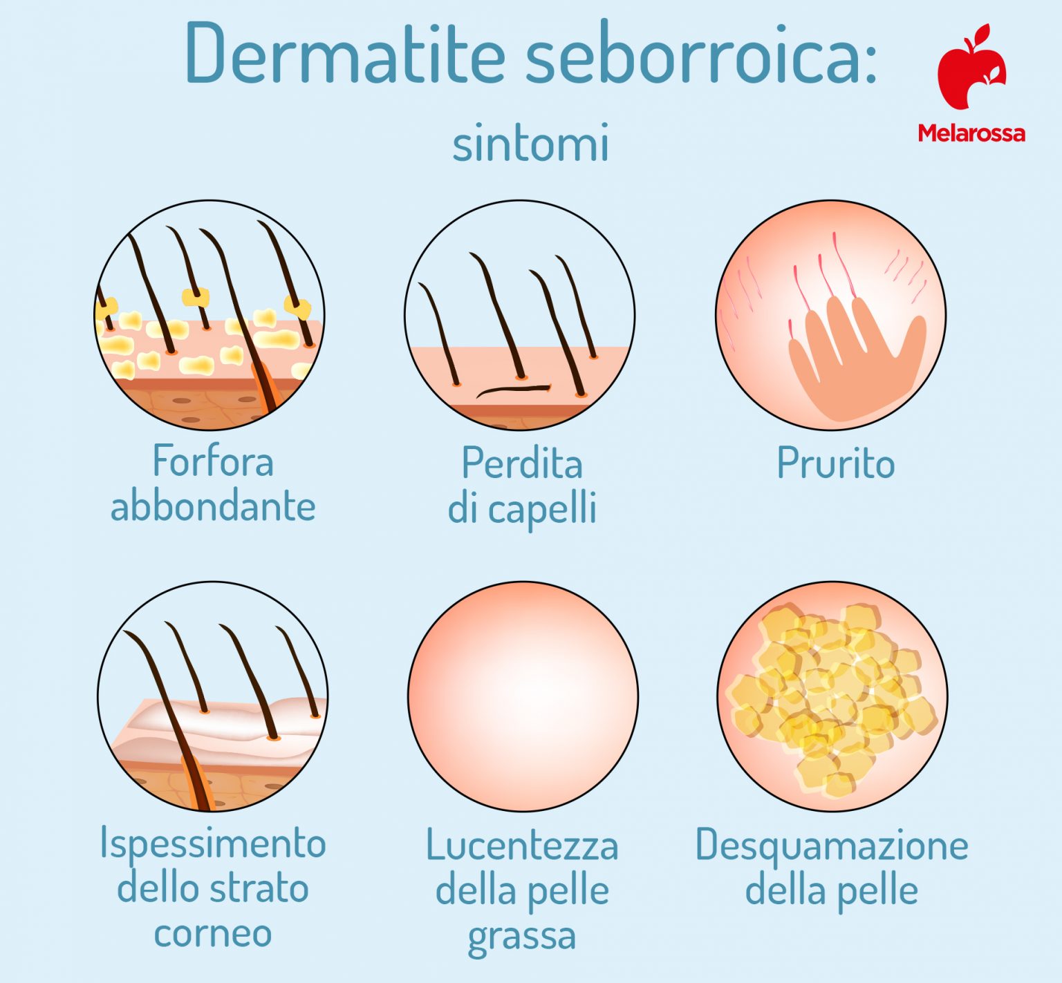 Dermatite Seborroica Cause Sintomi Trattamenti E Rimedi Naturali