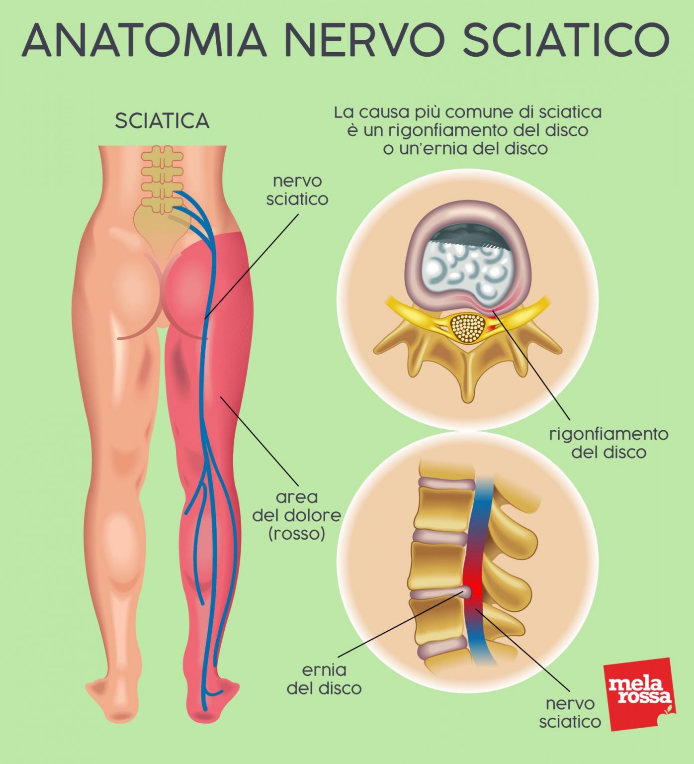 Lombosciatalgia Cosè Dolori Acuti E Cronici Cause Cure E Prevenzione 9803