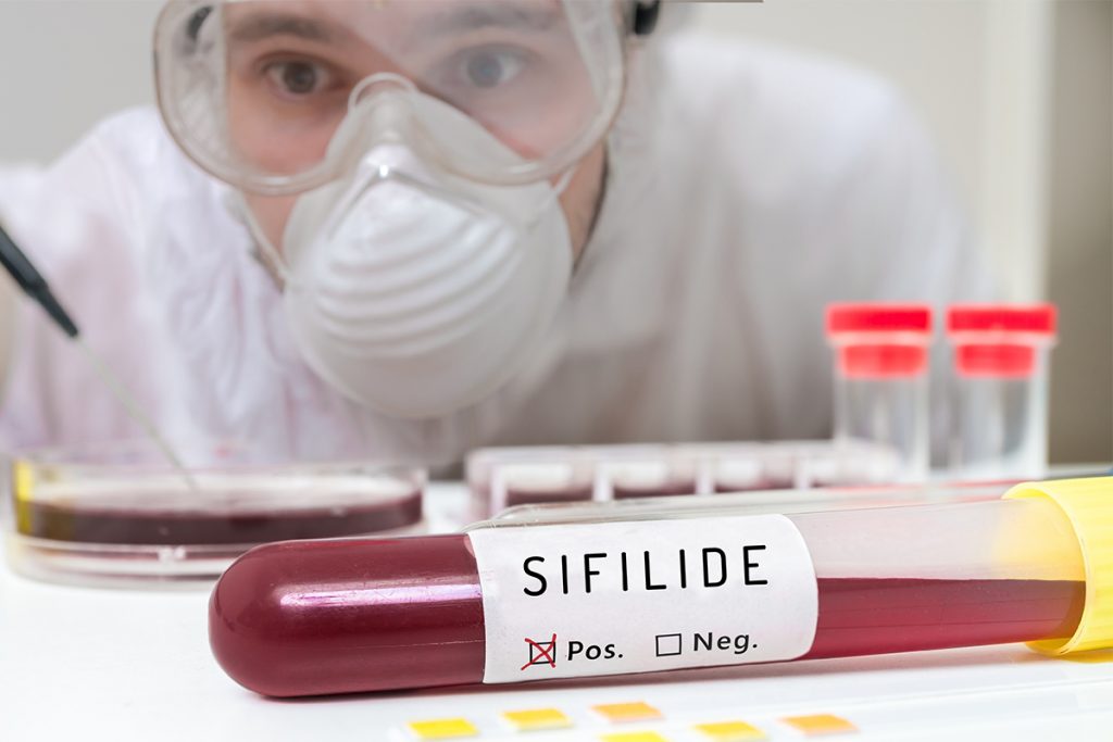 sifilide: cos'è, cause, sintomi e cure