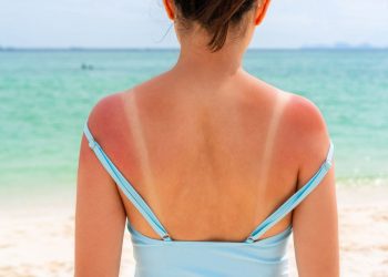 Una donna al mare che mostra sulla schiena i segni dell'eritema solare