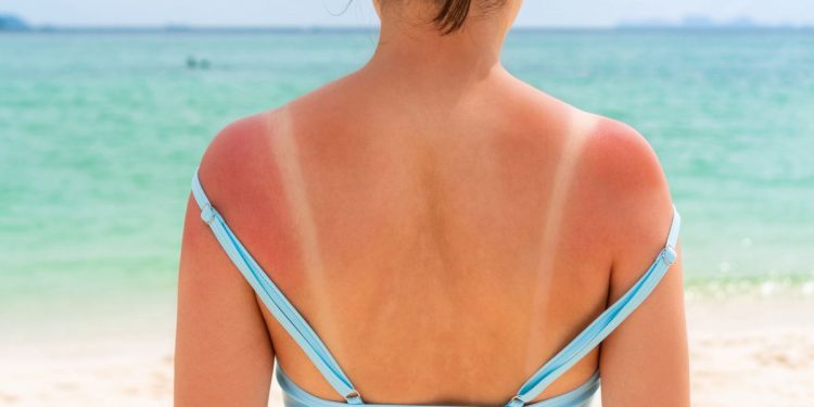 Una donna al mare che mostra sulla schiena i segni dell'eritema solare