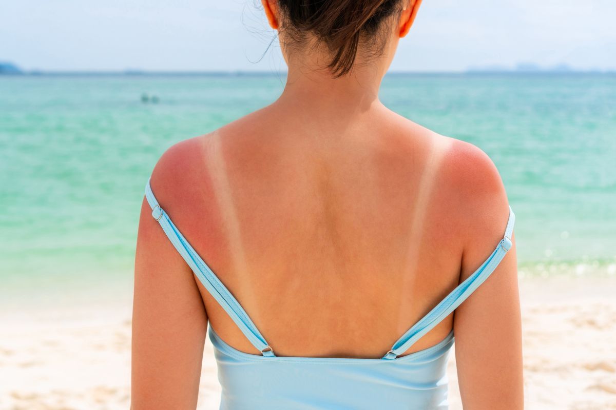 Una donna al mare che mostra sulla schiena i segni dell'eritema solare