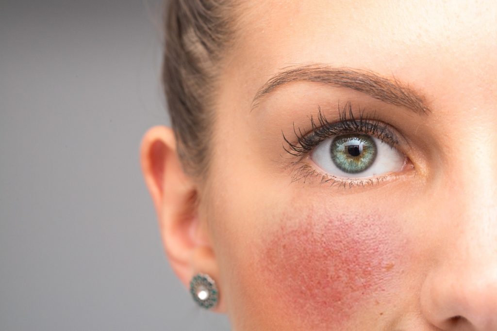 rosacea: cos'è, cause, sintomi e cure