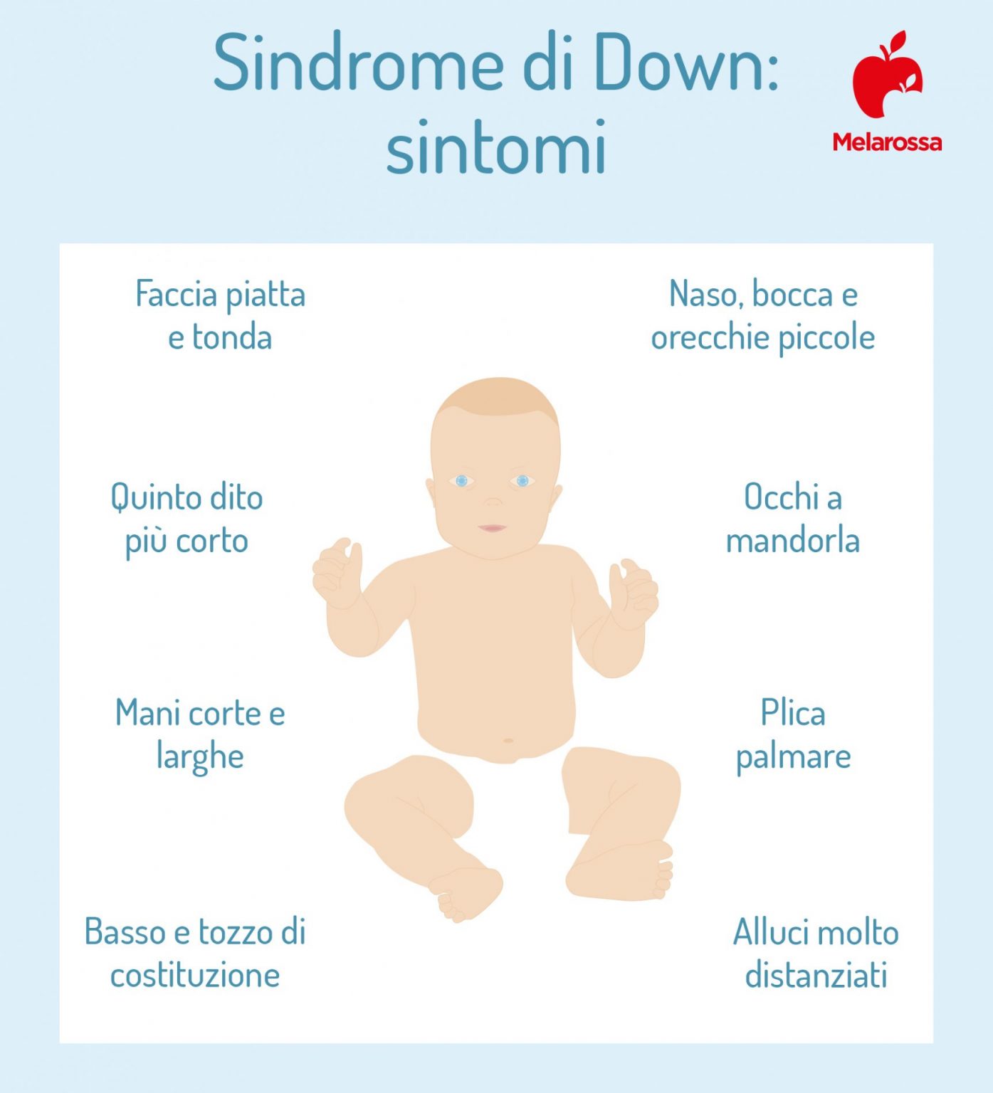 Sindrome di Down cos è cause sintomi diagnosi complicanze