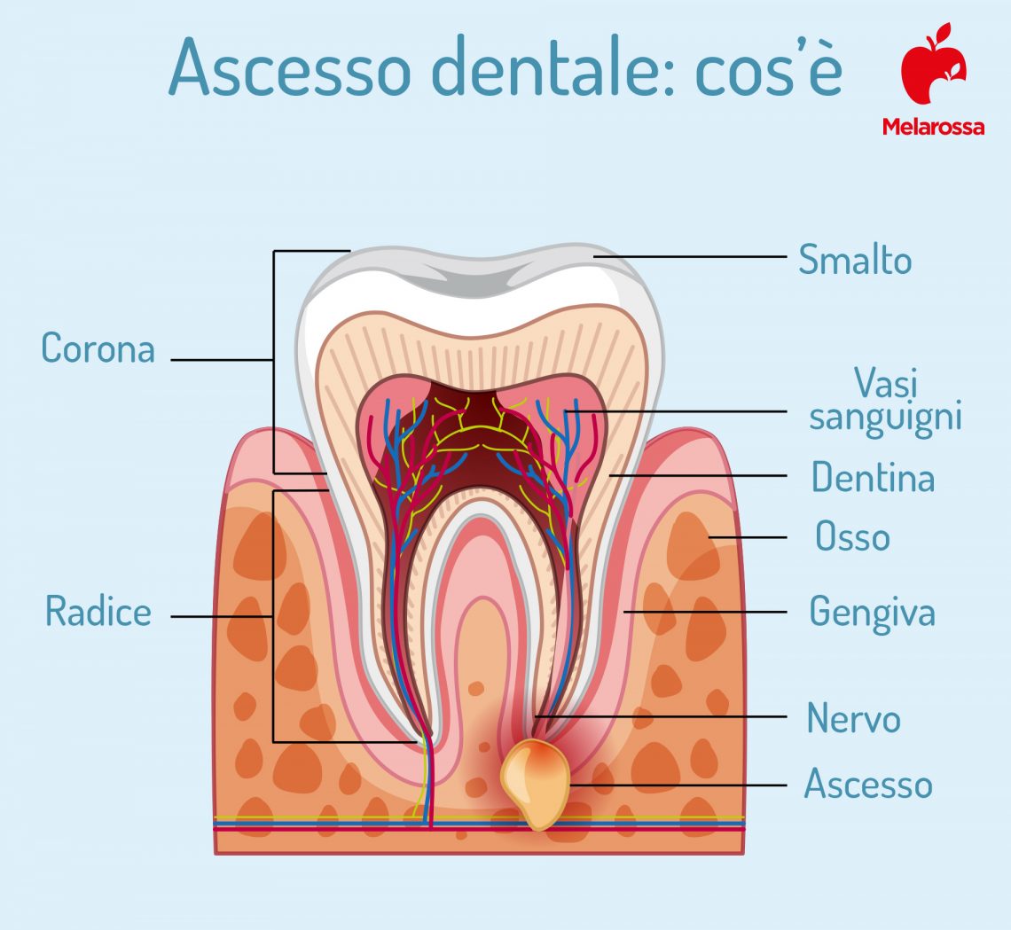 Ascesso Dentale Cos Cause Sintomi Cure Prevenzione