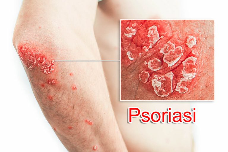 Psoriasi Cos Sintomi Tipi Cause Diagnosi E Cura Per Questa Patologia