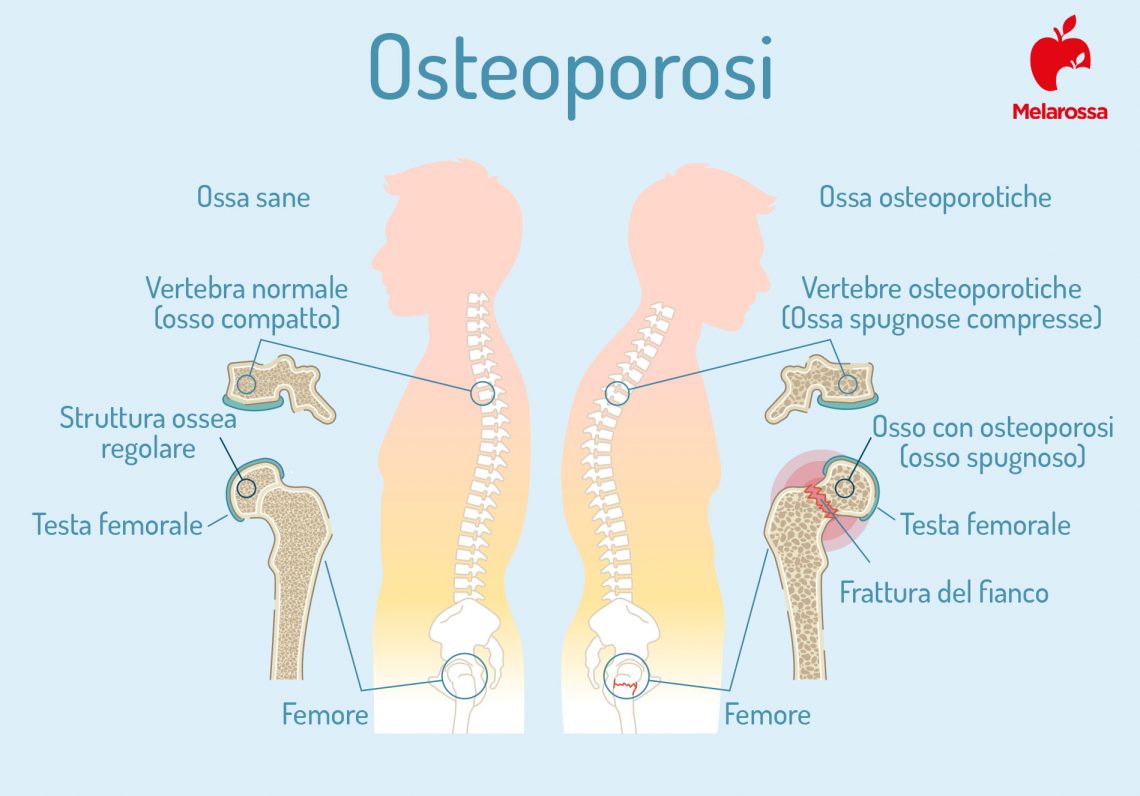 Osteoporosi Cos Sintomi Cura E Prevenzione Melarossa