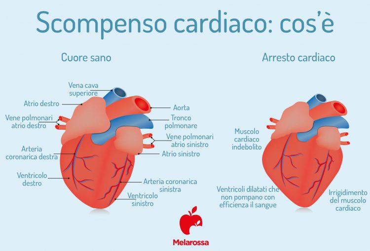 Scompenso Cardiaco: Cos’è, Tipologie, Sintomi, Cause, Diagnosi E Terapia