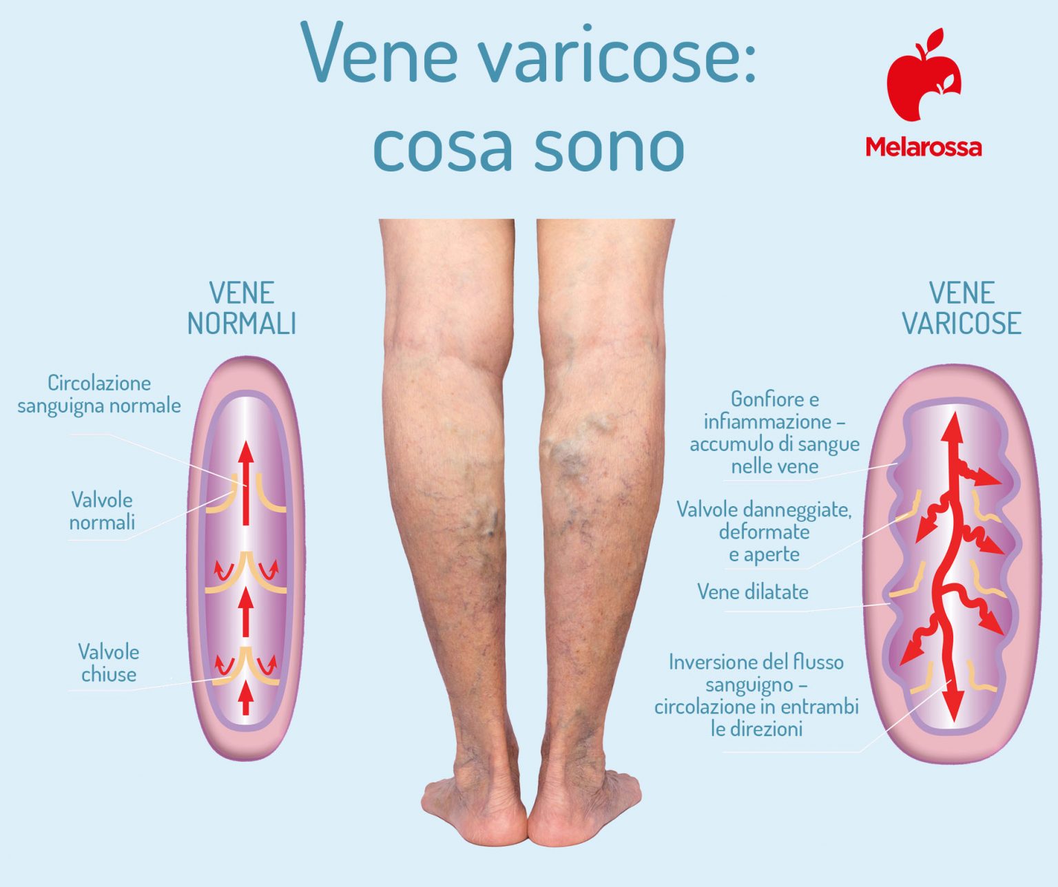 Vene Varicose Cosa Sono Sintomi Cause E Rimedi Delle Varici