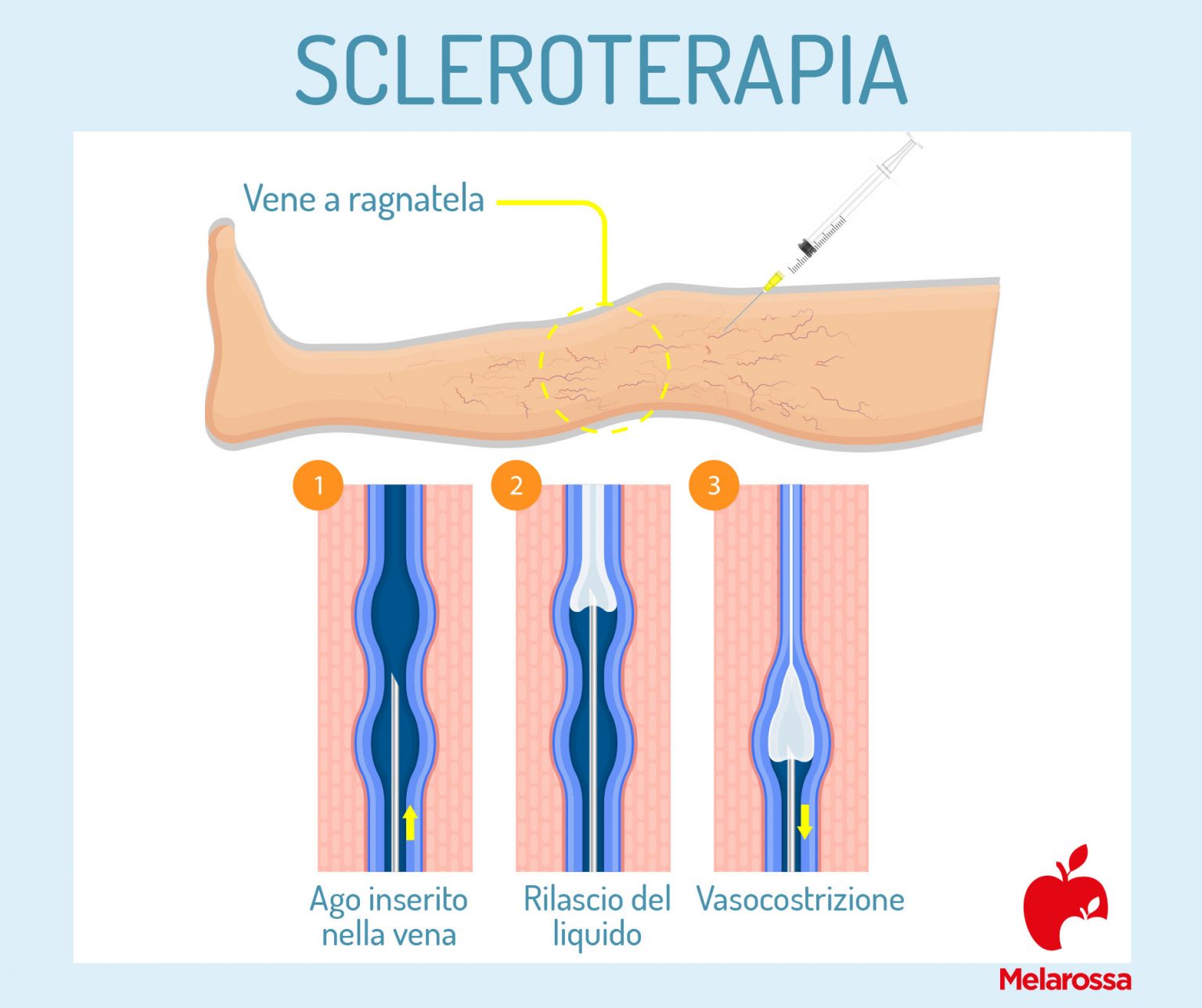 Vene Varicose Cosa Sono Sintomi Cause E Rimedi Delle Varici