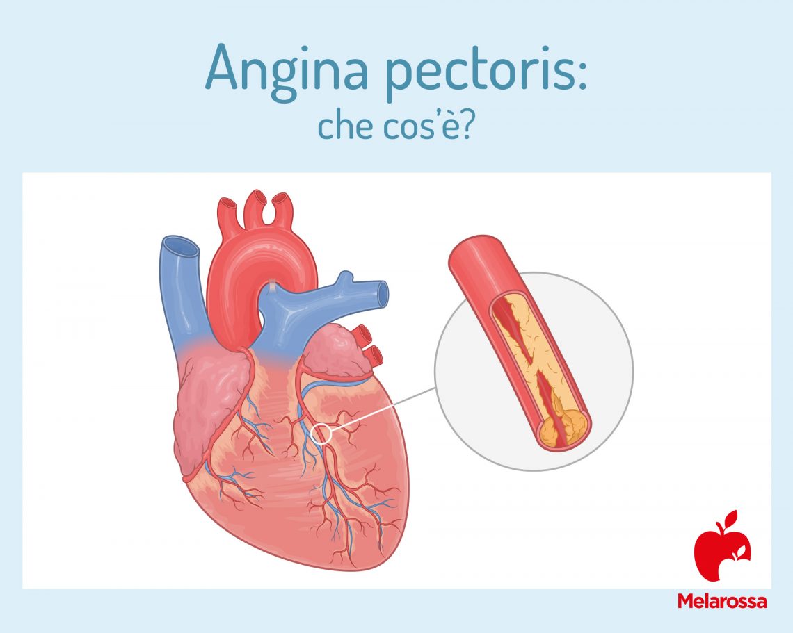 Angina Pectoris: cos'è, cause, sintomi, diagnosi, cure