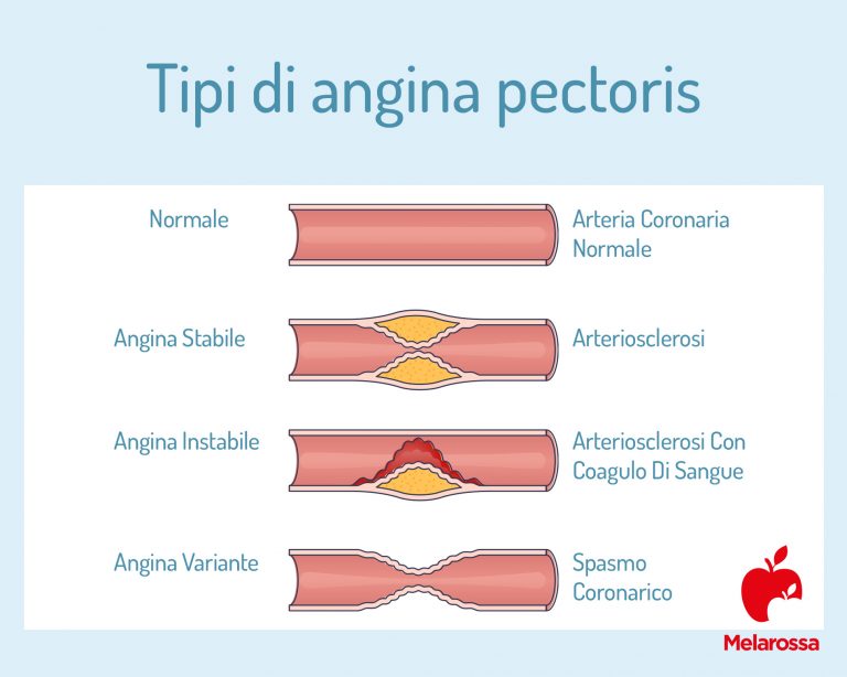 Angina Pectoris: cos'è, cause, sintomi, diagnosi, cure