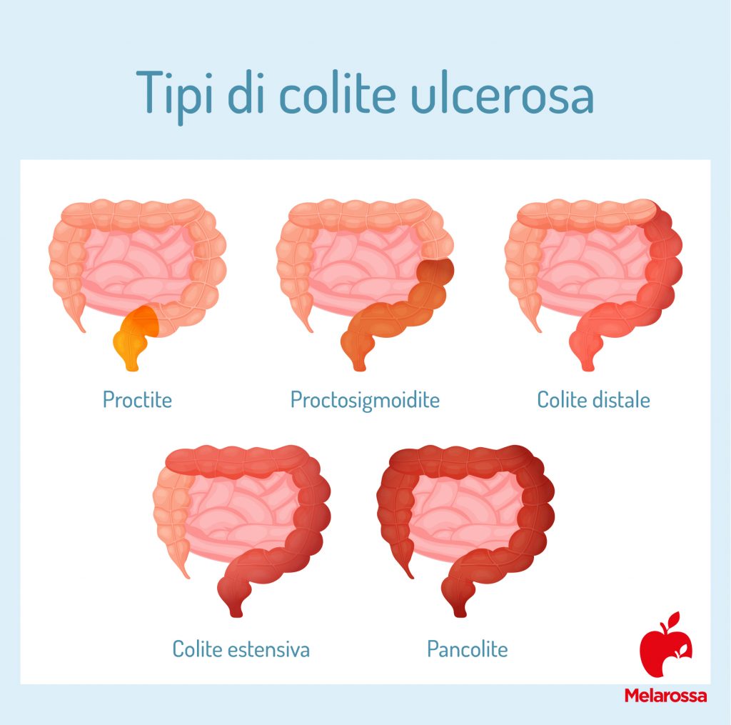 Colite ulcerosa che cos'è, sintomi, cause, cure e cosa mangiare